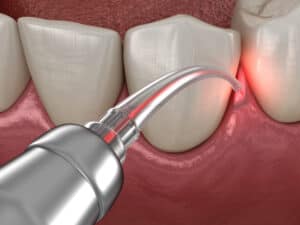 Laser dentistry in West Orange