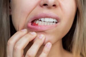 Bleeding gums in West Orange